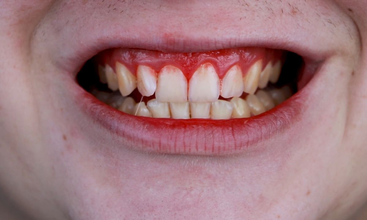 prikaz upale desni kod muškarca