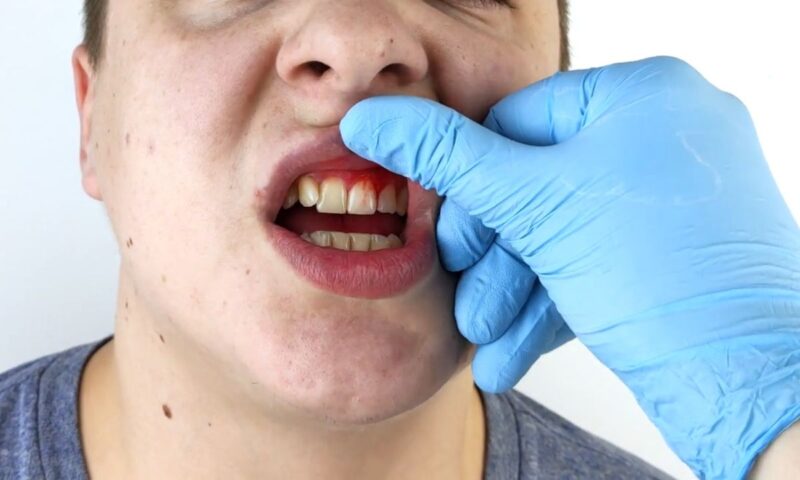 prikaz momka kom krvare desni