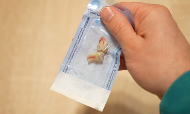 prikaz dva umnjaka u kesici